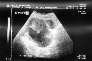 Sonar done on day 25 of cycle, showing cyst